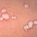 genital-warts-symptoms