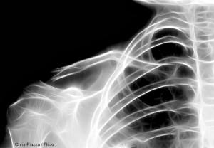 When x-rays show complicated and massive fractures, all you want is an orthopod but in a rural hospital, sometimes a girl's got to go it alone. (File photo)
